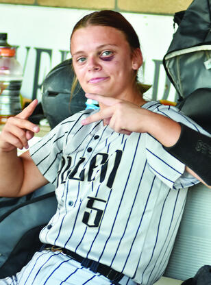 What happens when a bunt play goes wrong? Ayla Manuel found out with this beauty of a black eye.